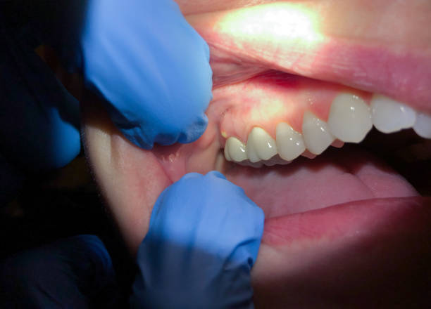 Best Knocked-Out Tooth Emergency  in Charleston, IL