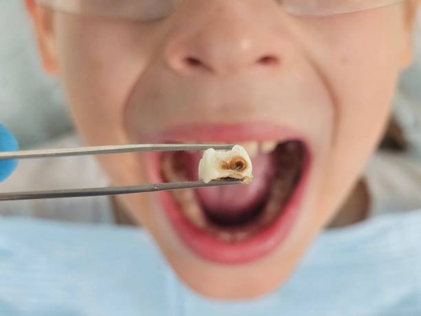 Best Cracked Tooth Emergency Dentist  in Charleston, IL
